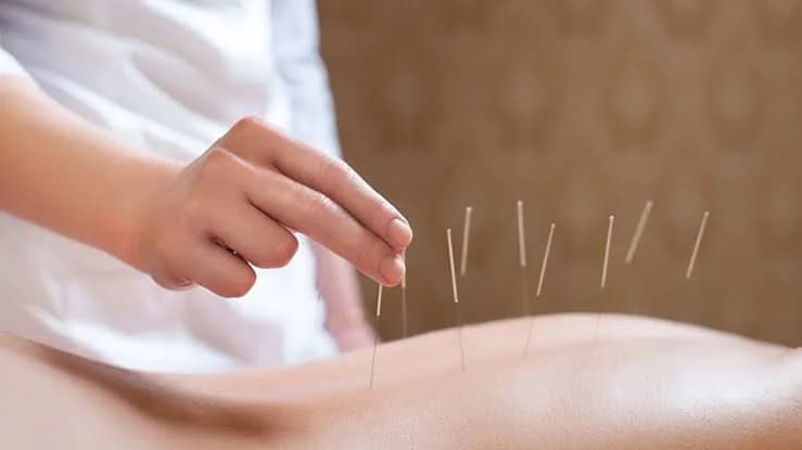 Sessão de acupuntura com aplicação de agulhas
