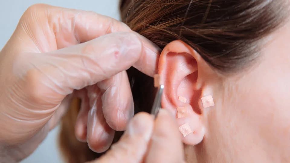 Auriculoterapia — aplicação de sementes na orelha